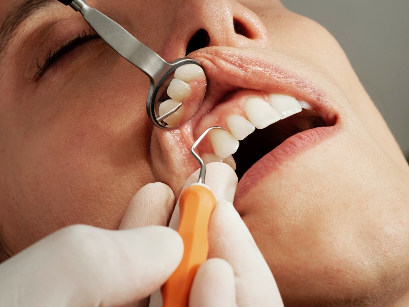 Signs You Need a Root Canal