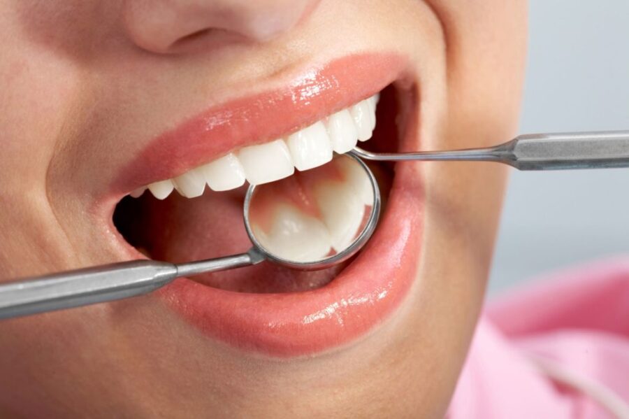 Dental Fillings: What You Need to Know